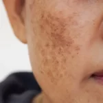 Melasma Meltdown