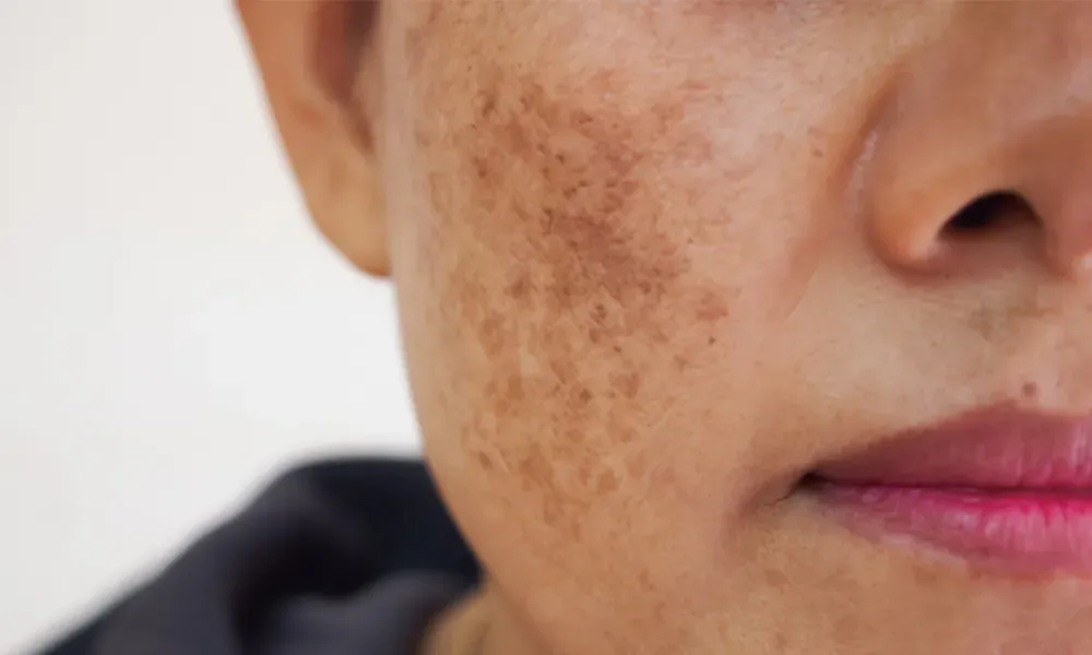 Melasma Meltdown