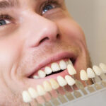Composite Veneer