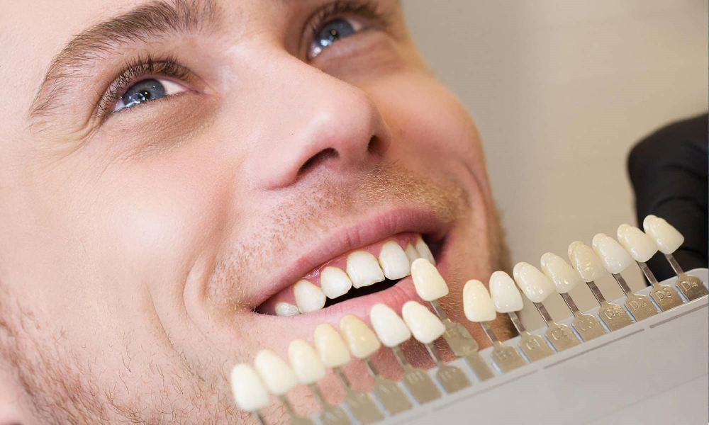 Composite Veneer